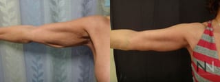 Before and after arm lift six months results - Angle 1