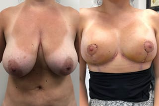 Breast contour improvement after reduction surgery - Angle 1