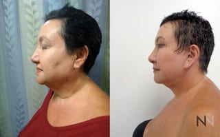 Lower face and neck contour improvement before and after - Angle 1
