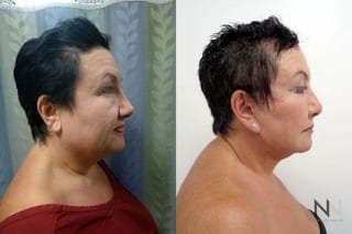 Lower face and neck contour improvement before and after - Angle 2