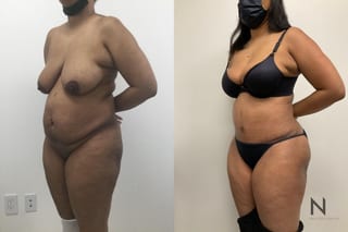 Liposuction 360 showing improved waist and flank contour - Angle 1