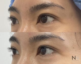 Upper blepharoplasty before and after eyelid contour improvement - Angle 2