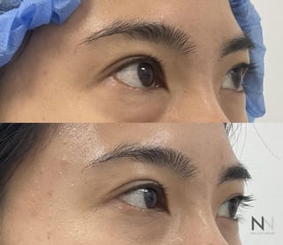 Upper blepharoplasty before and after eyelid contour improvement - Angle 3