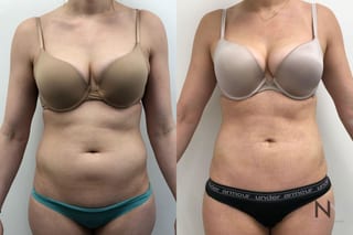 Awake liposuction abdomen and flank contour improvement - Angle 1