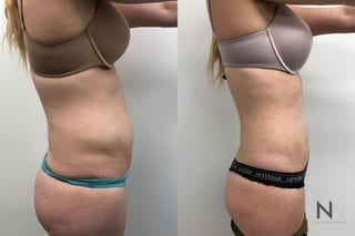 Awake liposuction abdomen and flank contour improvement - Angle 2