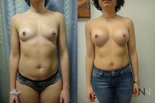 Breast augmentation before and after symmetry improvement - Angle 1