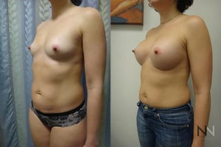 Breast augmentation before and after symmetry improvement - Angle 2