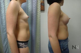 Breast augmentation before and after symmetry improvement - Angle 5