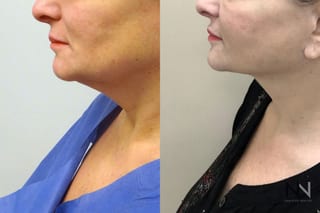 Neck lift before and after comparison frontal view - Angle 1