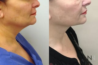 Neck lift before and after comparison frontal view - Angle 2