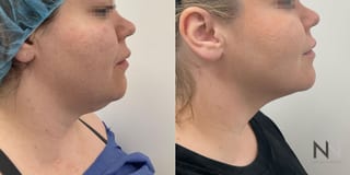 Before and after chin liposuction four months results - Angle 1