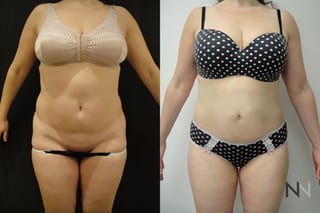 Before and after TICKLE liposuction flanks six months results - Angle 1