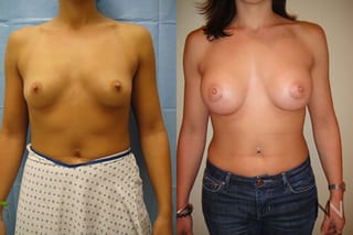 Breast contour enhancement six months post-op - Angle 1