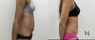 Before and after tummy tuck six months results - Angle 2
