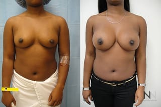 Before and after breast augmentation six months results - Angle 1