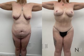 BBL and breast lift before and after transformation - Angle 1