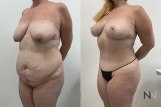 BBL and breast lift before and after transformation - Angle 2
