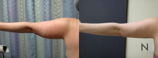 Before and after arm liposuction six months results - Angle 1