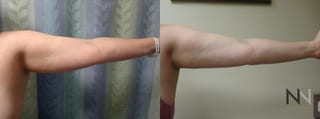 Before and after arm liposuction six months results - Angle 2