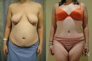 Before and after tummy tuck eight months results - Angle 1