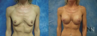 Breast augmentation before and after symmetry improvement - Angle 1