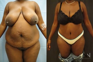 Abdominoplasty showing flatter abdomen and tighter skin - Angle 1