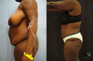 Abdominoplasty showing flatter abdomen and tighter skin - Angle 2