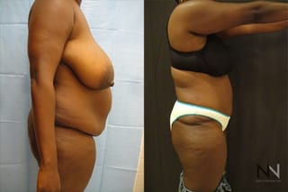 Abdominoplasty showing flatter abdomen and tighter skin - Angle 3