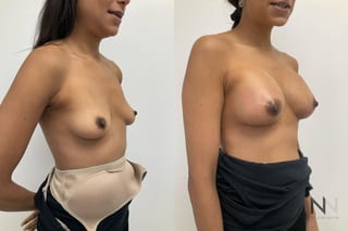 Breast augmentation before and after symmetry improvement - Angle 2