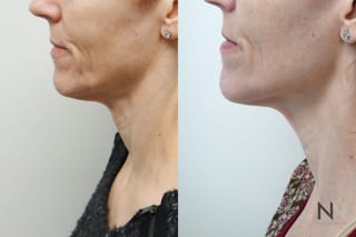 Before and after Ultherapy case 21289 - Angle 1