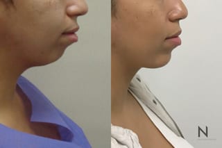 Chin augmentation before and after side profile comparison - Angle 2