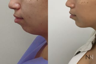 Chin augmentation before and after side profile comparison - Angle 1