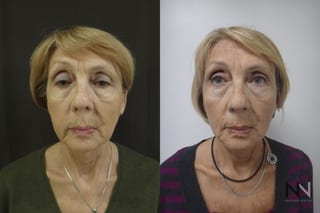 Before and after Ultherapy case 21295 - Angle 1