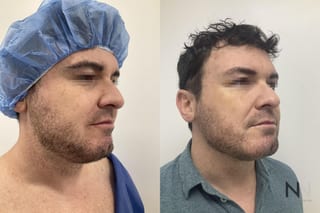 Submental liposuction showing improved jawline contour - Angle 2
