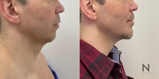 Jawline definition improvement after chin augmentation - Angle 1