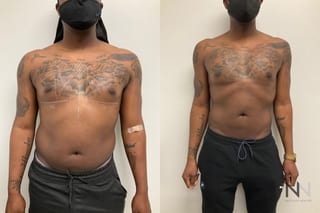 Before and after Pec Implants case 21324 - Angle 1