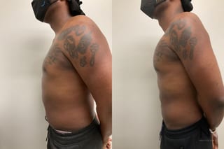 Before and after Pec Implants case 21324 - Angle 3