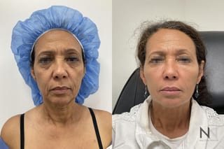 Fat grafting showing midface and cheek volume restoration - Angle 1