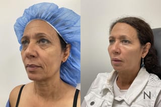 Fat grafting showing midface and cheek volume restoration - Angle 2