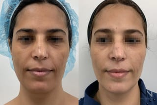 Fat grafting showing improved facial volume and contour - Angle 1
