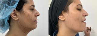 Fat grafting showing improved facial volume and contour - Angle 3