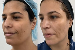 Fat grafting showing improved facial volume and contour - Angle 2