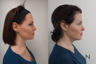 Lift & Tighten Naturally - Angle 1
