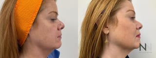 Before and after Ultherapy case 21332 - Angle 1