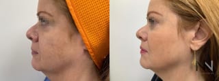 Before and after Ultherapy case 21332 - Angle 2