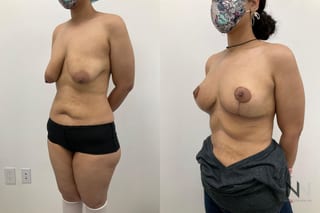 Before-and-after comparison showing improved breast balance, contour, and nipple position following right breast reduction and left breast mastopexy. - Angle 3