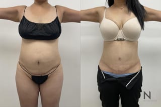 Abdominoplasty showing flatter abdomen and tighter skin - Angle 1
