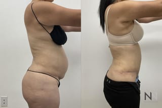 Abdominoplasty showing flatter abdomen and tighter skin - Angle 2