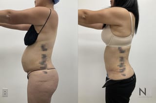 Abdominoplasty showing flatter abdomen and tighter skin - Angle 3