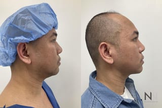 Submental liposuction showing improved jawline contour - Angle 5